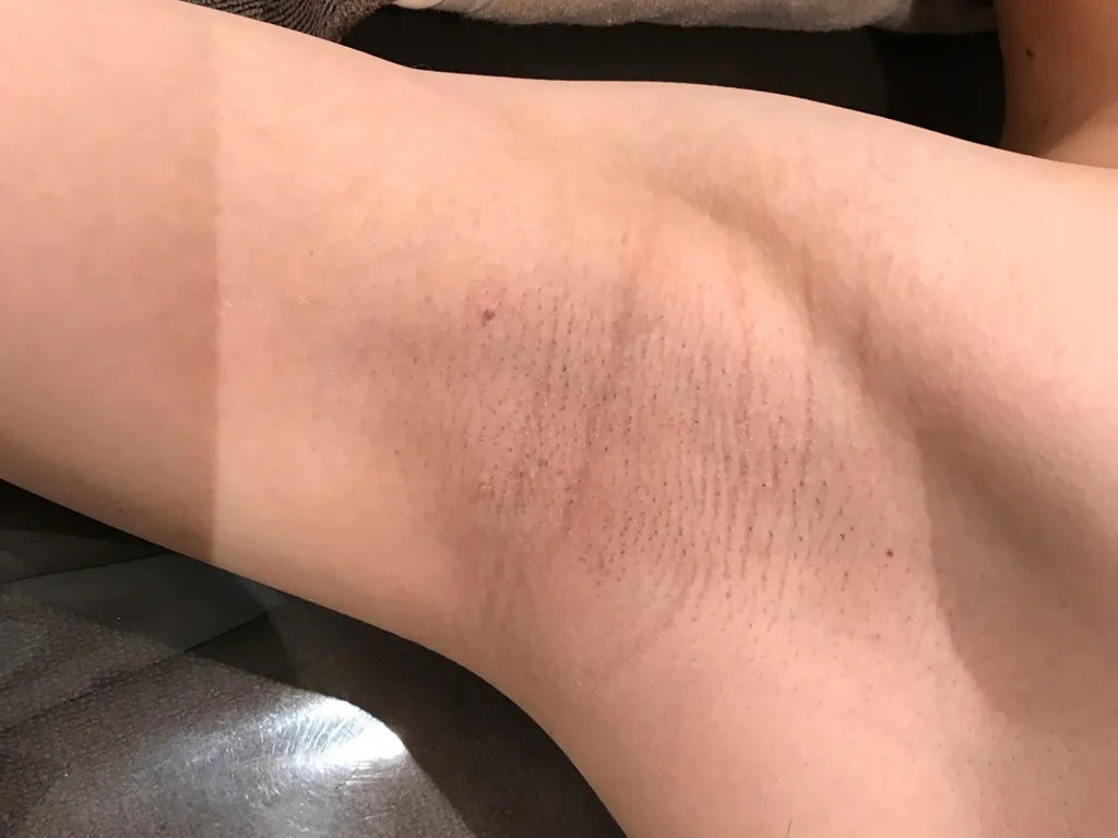 ビフォーアフター写真