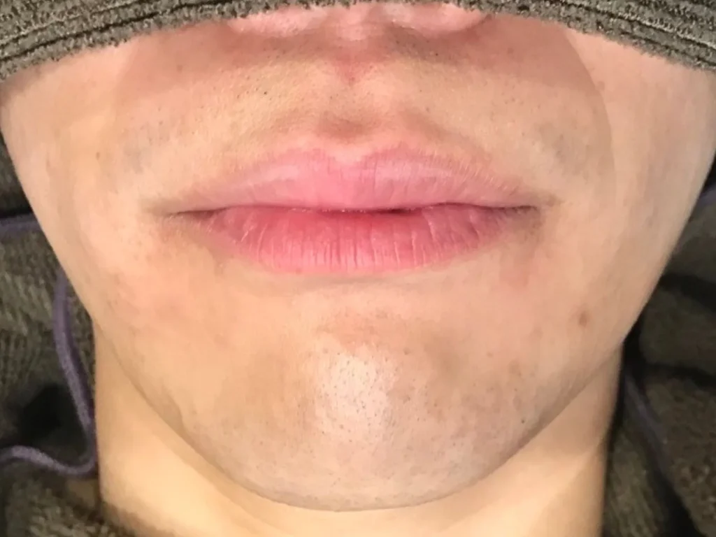 ビフォーアフター写真